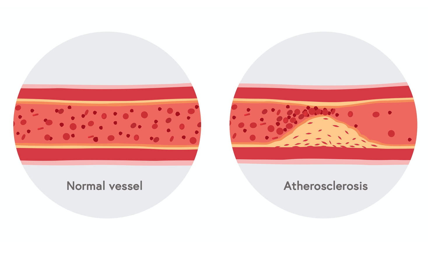 a normal vessel vs a vessel with atherosclerosis