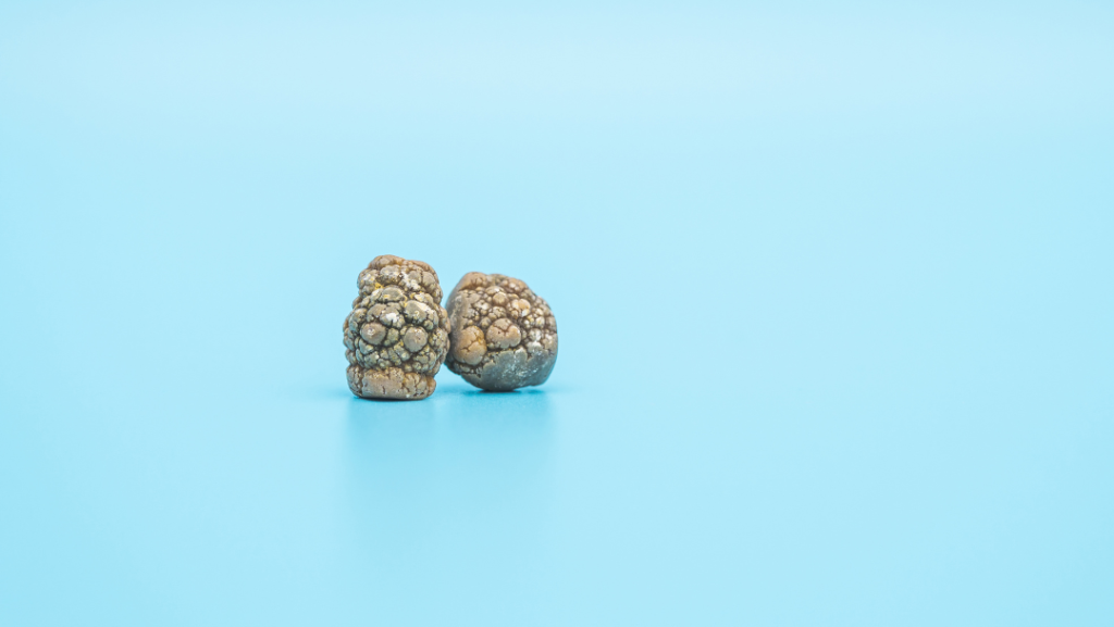 can you take glp-1 with gallstones Can you take Mounjaro with gallstones?