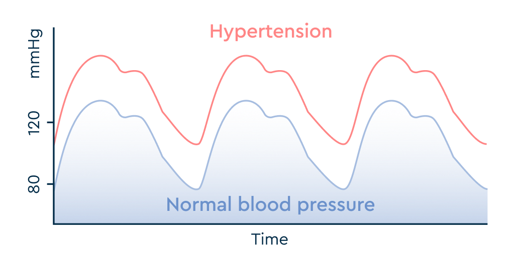 Graph comparing blood pressure over time, showing hypertension (consistently above 120 mmHg) versus normal blood pressure (fluctuating around 80-120 mmHg)